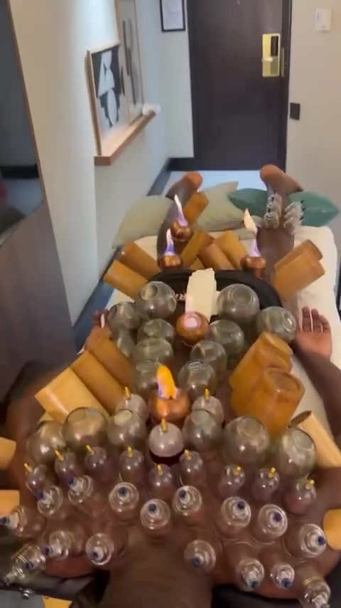 神秘力量！30岁奥纳纳恢复治疗，从肩部到小腿密密麻麻拔满罐！封面